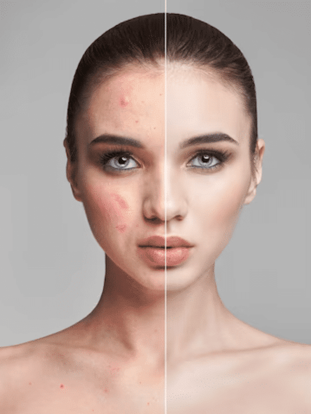 The Ultimate Acne Solution